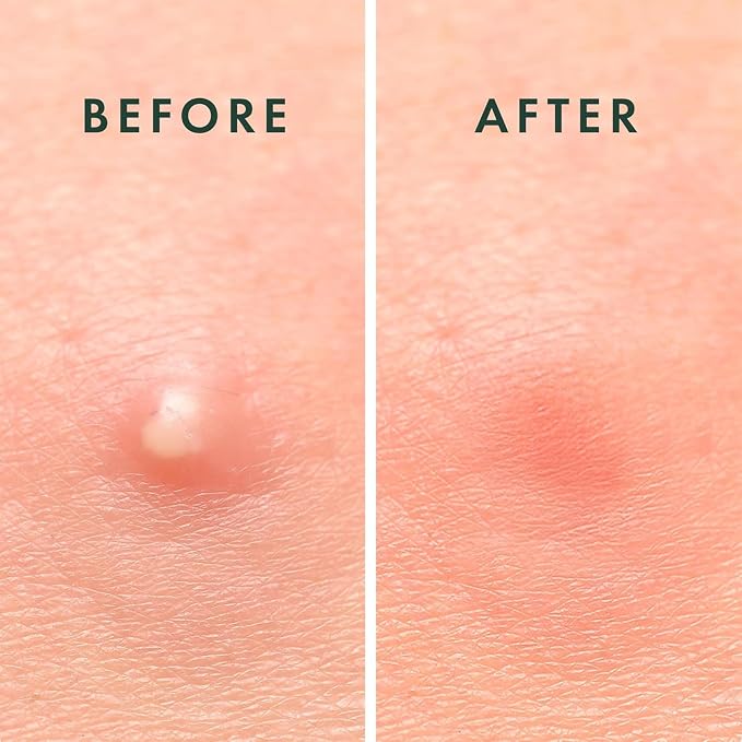 Daytime Pimple Patch