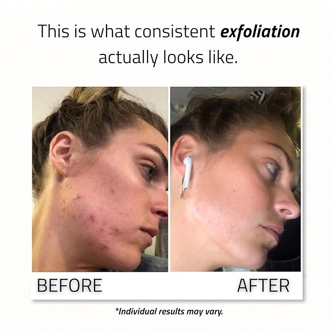 Glycolic 30% Peel 2oz