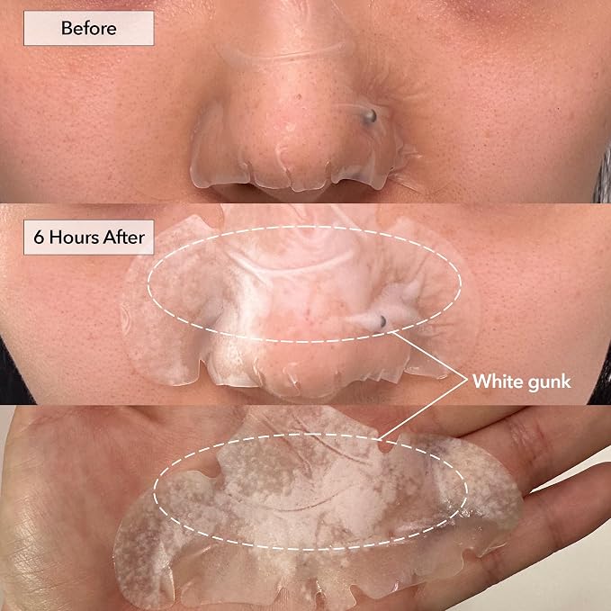 NOSE+ 10 PATCHES