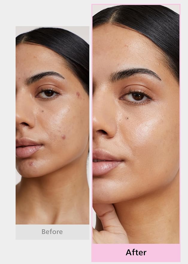 4-Type Pimple Patches