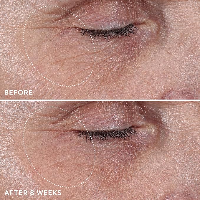 Eye Wrinkle Treatment